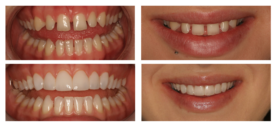 Dr. Marcum's patient's smile before and after procedures