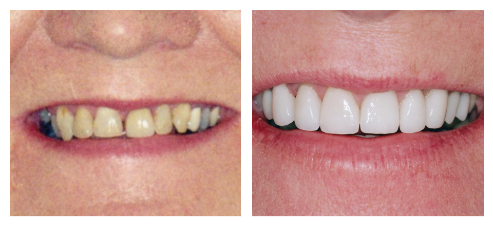 Dr. Marcum's patient's smile before and after procedures